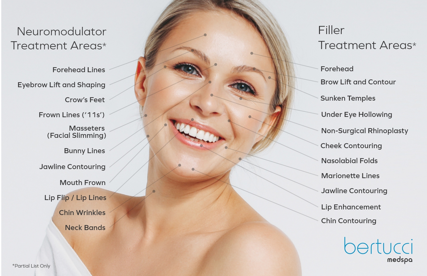 Model with Neuromodulator and Filler treatment areas located on their face.