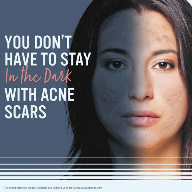 Facial acne scarring is no reason to hide

Consider seeking solutions through clinical research. The DAWN Study is seeking participants to evaluate whether an investigational treatment (a treatment not approved for clinical use) reduces facial acne scarring for adults.

You may be able to participate in the DAWN Study if you:

• Are at least 18 years old
• Have moderate to sever acne scars on each cheek
• Are interested in improving your facial atrophic acne scars

Qualified participants will receive all study-related care at no cost.

For more information, please call or email us at:

☎️: 905-850-4415
📧: contact@bertuccimedspa.com