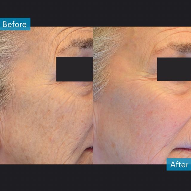 One of our go-to treatments to address signs of aging such as sunspots, fine lines, and wrinkles, is laser skin resurfacing. This patient is already seeing amazing results after just one session with our Fraxel DUAL laser. After a series of 2-3 sessions, we expect she will see even better skin quality improvements.

Fraxel DUAL laser rejuvenates the skin by stimulating the growth of new, healthy skin cells. This treatment is designed to address various skin concerns, including scars, blotchy pigmentation, fine lines, wrinkles, and stretch marks.

Call us today to book your consultation!

☎️: 905-850-4415
🧑‍💻: www.bertuccimedspa.com
📧: contact@bertuccimedspa.com
📍: 8333 Weston Rd, Suite 100, Woodbridge, ON

Disclaimer: All photos and videos are published with consent and are copyright Bertucci MedSpa. They are not to be used or distributed by others. Individual results will vary.

#YourSkinYourStory #Fraxel #Resurfacing #Medspa #Dermatologist #DrBertucci #BertucciMedSpa #BertucciDerm #Lasers #SkinCare #SkinHealth #SkinExpert