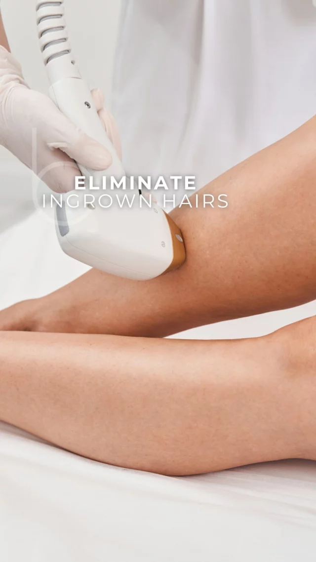 Stop those stubborn ingrown hairs with laser hair removal! ✨ 
  
No more bumps. No more irritation. Just smooth, happy skin. 💛 
  
#LaserHairRemoval #BertucciMedSpa #GoodbyeIngrowns #ConfidenceBoost #SelfCareWin  #SkinGoals #MedSpaTreatment 
 
☎️: 905-850-4415  
🧑‍💻: www.bertuccimedspa.com  
📧: contact@bertuccimedspa.com  
📍: 8333 Weston Rd, Suite 100, Woodbridge, ON